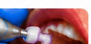Limpeza e higienização dental